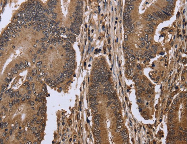 EIF3H / EIF3S3 Antibody - Immunohistochemistry of paraffin-embedded Human colon cancer using EIF3H Polyclonal Antibody at dilution of 1:50.