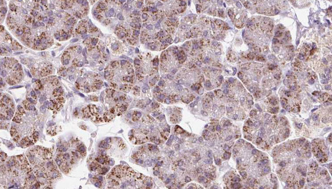 EIF3I / EIF3S2 Antibody - 1:100 staining human pancreas carcinoma tissue by IHC-P. The sample was formaldehyde fixed and a heat mediated antigen retrieval step in citrate buffer was performed. The sample was then blocked and incubated with the antibody for 1.5 hours at 22°C. An HRP conjugated goat anti-rabbit antibody was used as the secondary.