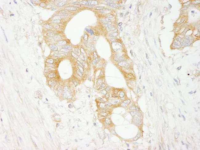 EIF3J Antibody - Detection of Human eIF3J/EIF3S1 by Immunohistochemistry. Sample: FFPE section of human colon carcinoma. Antibody: Affinity purified rabbit anti-eIF3J/EIF3S1 used at a dilution of 1:500.