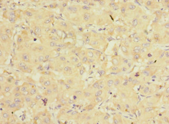 EIF3K Antibody - Immunohistochemistry of paraffin-embedded human liver cancer at dilution 1:100