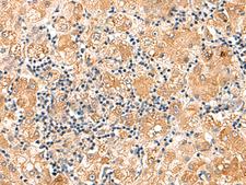 EIF3K Antibody - Immunohistochemistry of paraffin-embedded Human liver cancer tissue  using EIF3K Polyclonal Antibody at dilution of 1:75(×200)