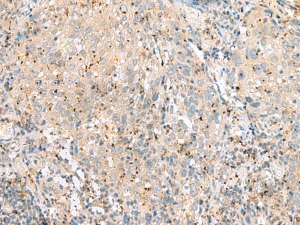 EIF3L / EIF3EIP Antibody - Immunohistochemistry of paraffin-embedded Human cervical cancer tissue  using EIF3L Polyclonal Antibody at dilution of 1:55(×200)
