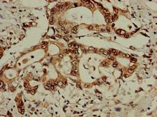 EIF3M / PCID1 Antibody - Immunohistochemistry of paraffin-embedded human pancreatic cancer at dilution of 1:100