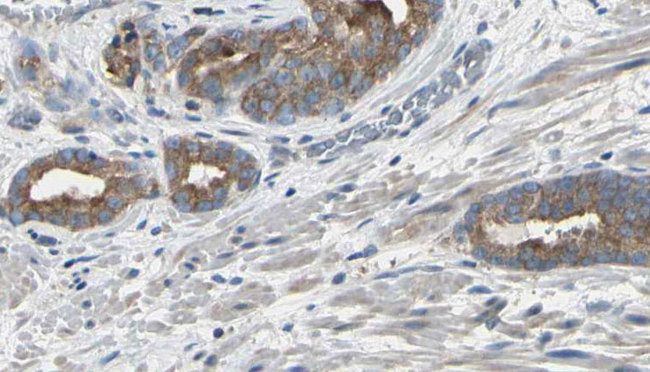 EIF3S5 / EIF3F Antibody - 1:100 staining human prostate tissue by IHC-P. The sample was formaldehyde fixed and a heat mediated antigen retrieval step in citrate buffer was performed. The sample was then blocked and incubated with the antibody for 1.5 hours at 22°C. An HRP conjugated goat anti-rabbit antibody was used as the secondary.