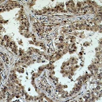 EIF4A1 Antibody - Immunohistochemical analysis of eIF4AI staining in human lung cancer formalin fixed paraffin embedded tissue section. The section was pre-treated using heat mediated antigen retrieval with sodium citrate buffer (pH 6.0). The section was then incubated with the antibody at room temperature and detected using an HRP conjugated compact polymer system. DAB was used as the chromogen. The section was then counterstained with hematoxylin and mounted with DPX.