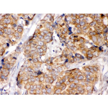EIF4A2 Antibody - eIF4A2 antibody IHC-paraffin. IHC(P): Human Mammary Cancer Tissue.