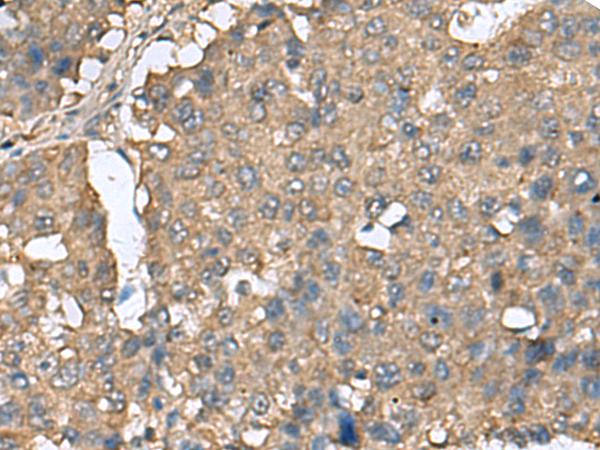 EIF4A2 Antibody - Immunohistochemistry of paraffin-embedded Human liver cancer tissue  using EIF4A2 Polyclonal Antibody at dilution of 1:65(×200)