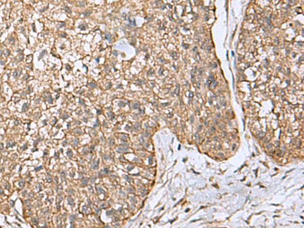 EIF4A2 Antibody - Immunohistochemistry of paraffin-embedded Human esophagus cancer tissue  using EIF4A2 Polyclonal Antibody at dilution of 1:65(×200)