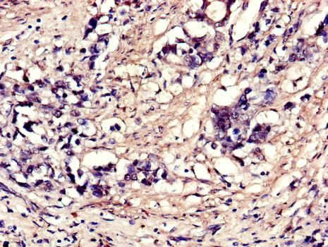 EIF4A3 Antibody - Immunohistochemistry of paraffin-embedded human gastric cancer using EIF4A3 Antibody at dilution of 1:100