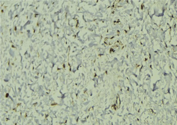 EIF4A3 Antibody - 1:100 staining human breast carcinoma tissue by IHC-P. The sample was formaldehyde fixed and a heat mediated antigen retrieval step in citrate buffer was performed. The sample was then blocked and incubated with the antibody for 1.5 hours at 22°C. An HRP conjugated goat anti-rabbit antibody was used as the secondary.
