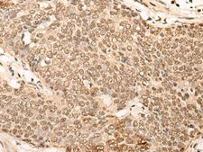 EIF4A3 Antibody - Immunohistochemistry of paraffin-embedded Human esophagus cancer tissue  using EIF4A3 Polyclonal Antibody at dilution of 1:45(×200)