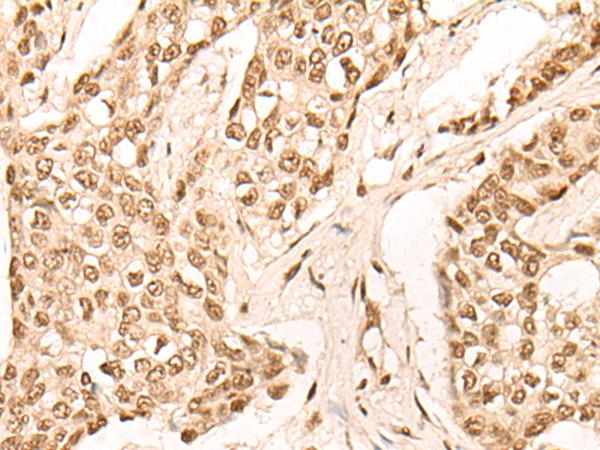 EIF4A3 Antibody - Immunohistochemistry of paraffin-embedded Human breast cancer tissue  using EIF4A3 Polyclonal Antibody at dilution of 1:45(×200)