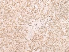 EIF4A3 Antibody - Immunohistochemistry of paraffin-embedded Human ovarian cancer tissue  using EIF4A3 Polyclonal Antibody at dilution of 1:35(×200)