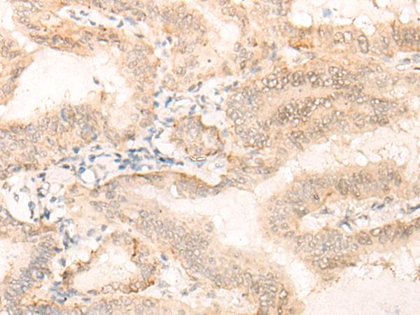 EIF4A3 Antibody - Immunohistochemistry of paraffin-embedded Human thyroid cancer tissue  using EIF4A3 Polyclonal Antibody at dilution of 1:35(×200)