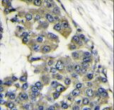EIF4B Antibody - Formalin-fixed and paraffin-embedded human breast carcinoma reacted with EIF4B antibody , which was peroxidase-conjugated to the secondary antibody, followed by DAB staining. This data demonstrates the use of this antibody for immunohistochemistry; clinical relevance has not been evaluated.