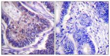 EIF4B Antibody - Immunohistochemistry analysis of paraffin-embedded human colon carcinoma tissue, using eIF4B Antibody. The picture on the right is blocked with the synthesized peptide.
