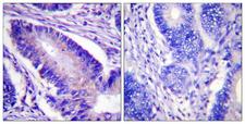 EIF4B Antibody - Immunohistochemistry analysis of paraffin-embedded human colon carcinoma, using eIF4B (Phospho-Ser422) Antibody. The picture on the right is blocked with the phospho peptide.