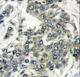 EIF4E Antibody - Formalin-fixed and paraffin-embedded human breast carcinoma reacted with EIF4E antibody , which was peroxidase-conjugated to the secondary antibody, followed by DAB staining. This data demonstrates the use of this antibody for immunohistochemistry; clinical relevance has not been evaluated.