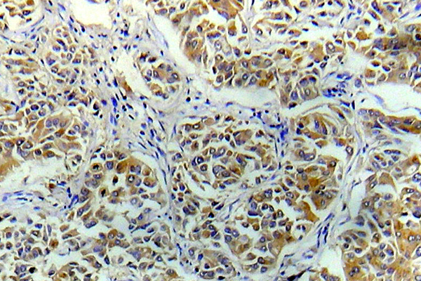 EIF4E Antibody - IHC of eIF4E (R215) pAb in paraffin-embedded human breast carcinoma tissue.