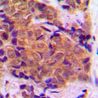EIF4E Antibody - Immunohistochemical analysis of EIF4E staining in human breast cancer formalin fixed paraffin embedded tissue section. The section was pre-treated using heat mediated antigen retrieval with sodium citrate buffer (pH 6.0). The section was then incubated with the antibody at room temperature and detected using an HRP conjugated compact polymer system. DAB was used as the chromogen. The section was then counterstained with hematoxylin and mounted with DPX.