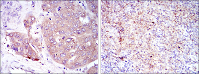 EIF4E Antibody - IHC of paraffin-embedded liver cancer (left) and submaxillary tumor (right) using EIF4E mouse monoclonal antibody with DAB staining.