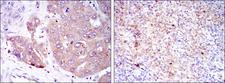 EIF4E Antibody - IHC of paraffin-embedded liver cancer (left) and submaxillary tumor (right) using EIF4E mouse monoclonal antibody with DAB staining.