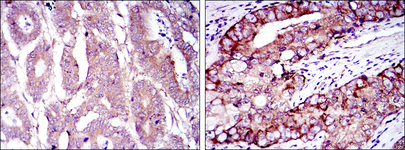 EIF4E Antibody - IHC of paraffin-embedded stomach cancer (left) and prostate cancer (right) using EIF4E mouse monoclonal antibody with DAB staining.