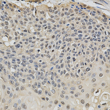 EIF4E Antibody - Immunohistochemistry of paraffin-embedded human esophageal cancer tissue.