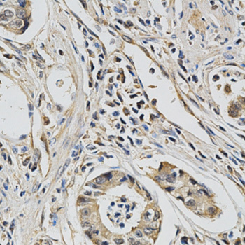 EIF4E Antibody - Immunohistochemistry of paraffin-embedded human stomach cancer tissue.