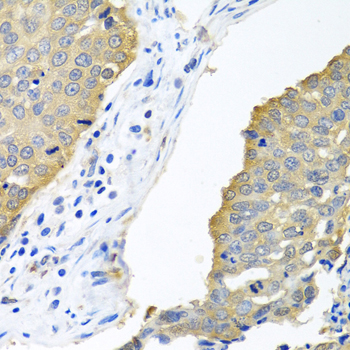 EIF4E Antibody - Immunohistochemistry of paraffin-embedded human lung cancer tissue.