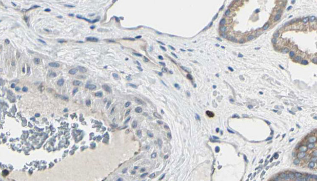 EIF4E Antibody - 1:100 staining human prostate tissue by IHC-P. The sample was formaldehyde fixed and a heat mediated antigen retrieval step in citrate buffer was performed. The sample was then blocked and incubated with the antibody for 1.5 hours at 22°C. An HRP conjugated goat anti-rabbit antibody was used as the secondary.
