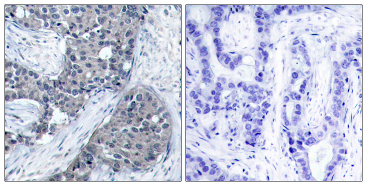 EIF4E Antibody - Immunohistochemistry analysis of paraffin-embedded human breast carcinoma, using eIF4E (Phospho-Ser209) Antibody. The picture on the right is blocked with the phospho peptide.