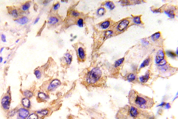 EIF4E Antibody - IHC of p-eIF4E (S209) pAb in paraffin-embedded human breast carcinoma tissue.