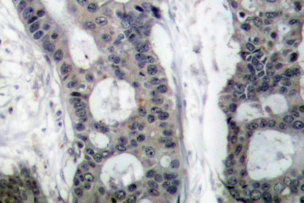 EIF4E Antibody - IHC of eIF4E (T203) pAb in paraffin-embedded human breast carcinoma tissue.