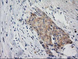 EIF4E2 / IF4e Antibody - IHC of paraffin-embedded Adenocarcinoma of Human breast tissue using anti-EIF4E2 mouse monoclonal antibody. (Heat-induced epitope retrieval by 10mM citric buffer, pH6.0, 100C for 10min).
