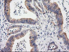 EIF4E2 / IF4e Antibody - IHC of paraffin-embedded Adenocarcinoma of Human colon tissue using anti-EIF4E2 mouse monoclonal antibody. (Heat-induced epitope retrieval by 10mM citric buffer, pH6.0, 100C for 10min).