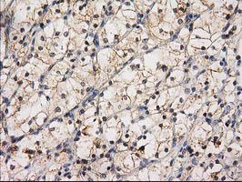 EIF4E2 / IF4e Antibody - IHC of paraffin-embedded Carcinoma of Human kidney tissue using anti-EIF4E2 mouse monoclonal antibody. (Heat-induced epitope retrieval by 10mM citric buffer, pH6.0, 100C for 10min).