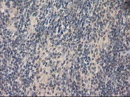 EIF4E2 / IF4e Antibody - IHC of paraffin-embedded Human lymphoma tissue using anti-EIF4E2 mouse monoclonal antibody. (Heat-induced epitope retrieval by 10mM citric buffer, pH6.0, 100C for 10min).