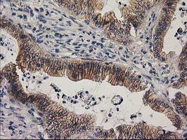 EIF4E2 / IF4e Antibody - IHC of paraffin-embedded Adenocarcinoma of Human colon tissue using anti-EIF4E2 mouse monoclonal antibody. (Heat-induced epitope retrieval by 10mM citric buffer, pH6.0, 100C for 10min).