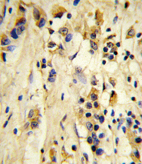 EIF4E2 / IF4e Antibody - Formalin-fixed and paraffin-embedded human breast carcinoma reacted with EIF4E2 Antibody, which was peroxidase-conjugated to the secondary antibody, followed by DAB staining. This data demonstrates the use of this antibody for immunohistochemistry; clinical relevance has not been evaluated.