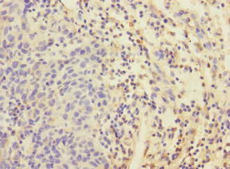 EIF4E2 / IF4e Antibody - Immunohistochemistry of paraffin-embedded human bladder cancer at dilution 1:100