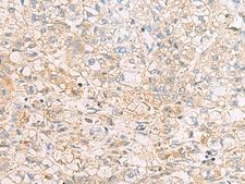 EIF4E2 / IF4e Antibody - Immunohistochemistry of paraffin-embedded Human liver cancer tissue  using EIF4E2 Polyclonal Antibody at dilution of 1:50(×200)