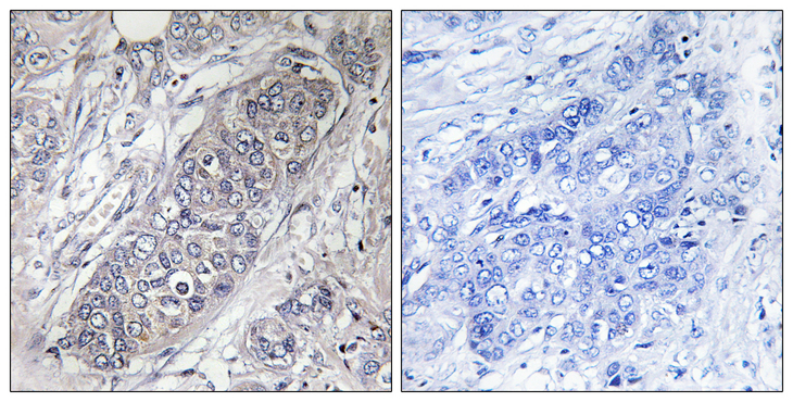 EIF4EBP1 / 4EBP1 Antibody - Immunohistochemistry analysis of paraffin-embedded human breast carcinoma tissue, using 4E-BP1 Antibody. The picture on the right is blocked with the synthesized peptide.