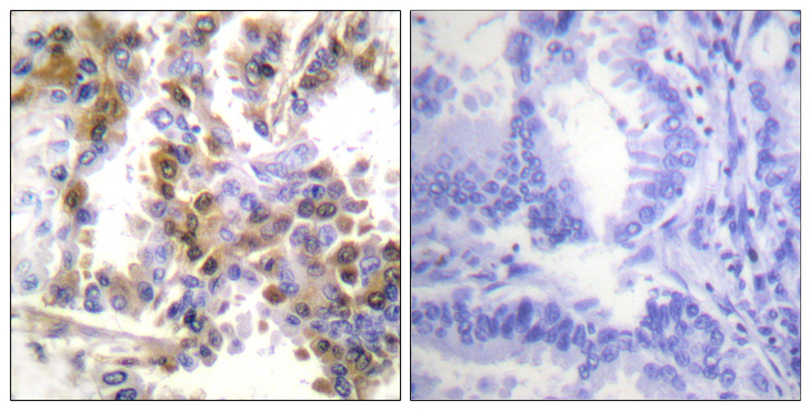 EIF4EBP1 / 4EBP1 Antibody - Immunohistochemistry analysis of paraffin-embedded human lung carcinoma tissue, using 4E-BP1 Antibody. The picture on the right is blocked with the synthesized peptide.