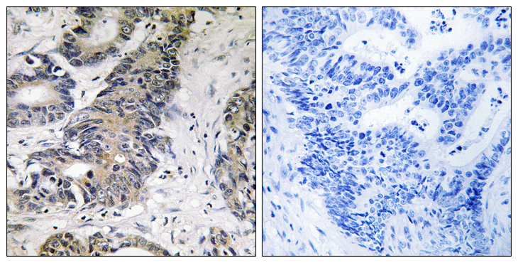EIF4EBP1 / 4EBP1 Antibody - Immunohistochemistry analysis of paraffin-embedded human colon carcinoma, using 4E-BP1 Antibody. The picture on the right is blocked with the synthesized peptide.