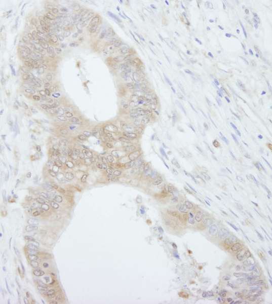 EIF4EBP1 / 4EBP1 Antibody - Detection of Human 4EBP1 by Immunohistochemistry. Sample: FFPE section of human colon carcinoma. Antibody: Affinity purified rabbit anti-4EBP1 used at a dilution of 1:250.