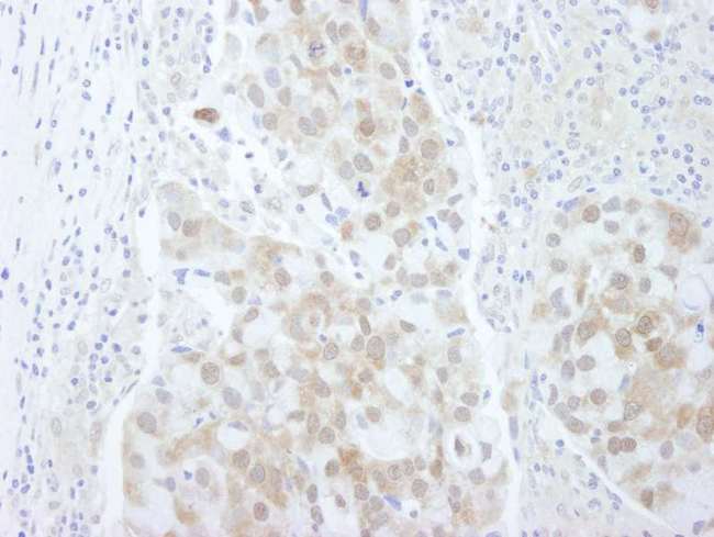 EIF4EBP1 / 4EBP1 Antibody - Detection of Human 4EBP1 by Immunohistochemistry. Sample: FFPE section of human breast carcinoma. Antibody: Affinity purified rabbit anti-4EBP1 used at a dilution of 1:250.