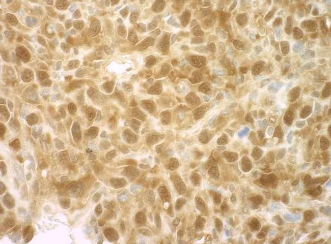 EIF4EBP1 / 4EBP1 Antibody - Detection of Mouse 4EBP1 by Immunohistochemistry. Sample: FFPE section of mouse squamous cell carcinoma. Antibody: Affinity purified rabbit anti-4EBP1 used at a dilution of 1:50.