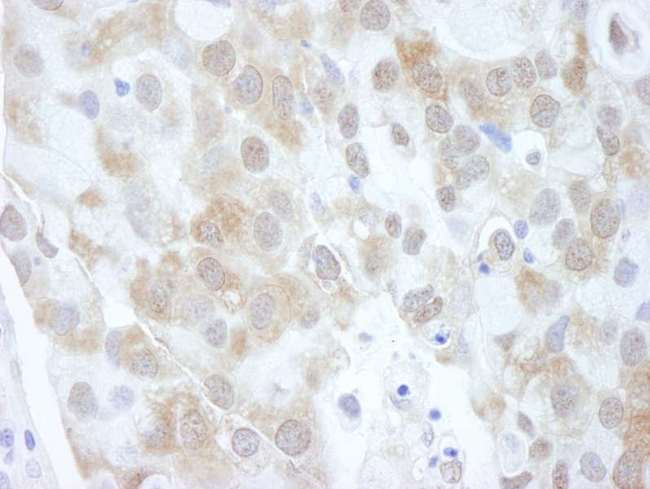 EIF4EBP1 / 4EBP1 Antibody - Detection of Human 4EBP1 by Immunohistochemistry. Sample: FFPE section of human breast carcinoma. Antibody: Affinity purified rabbit anti-4EBP1 used at a dilution of 1:20000 (0.05 ug/ml).