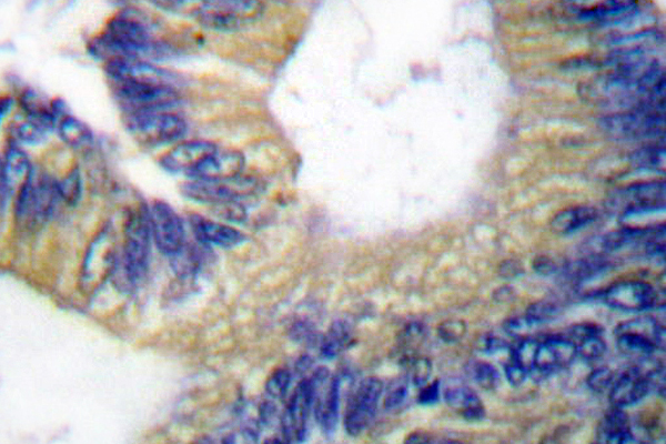 EIF4EBP1 / 4EBP1 Antibody - IHC of 4E-BP1 (N63) pAb in paraffin-embedded human colon carcinoma tissue.